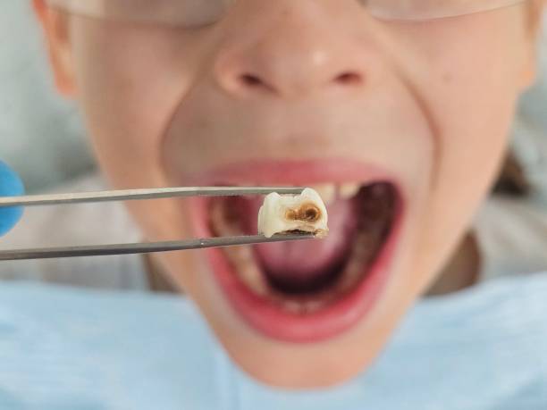 Best Emergency Tooth Extraction in Higginsville, MO